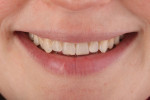 In a reverse or concave smile, the incisal edge outline is not congruent with the outline of the lower lip border. Correcting the incisal line to a more convex form creates radiating symmetry with the lower lip for a more esthetic smile.