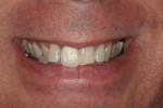 Patients with excessive buccal space could benefit from smile improvements extending beyond the anterior teeth. In attempts to correct anterior tooth violations, the buccal corridor deficiency could be inadvertently emphasized, creating an artificial looking smile. Extending the smile from the anterior IPS e.max restorations to the directly restored bicuspids established a more ideal buccal width.