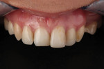 Loss of central dominance often occurs in cases with crowding and restorations will straighten the teeth. Uprighting the teeth to correct the anterior lingual tipping created restorative space for the restorations and established ideal central-to-lateral proportions. IPS e.max and IPS Empress restorations idealized the arch form and established central dominance.