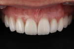 Loss of central dominance often occurs in cases with crowding and restorations will straighten the teeth. Uprighting the teeth to correct the anterior lingual tipping created restorative space for the restorations and established ideal central-to-lateral proportions. IPS e.max and IPS Empress restorations idealized the arch form and established central dominance.