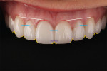 Gingival esthetics is crucial in smile design, and understanding ideal gingival position parameters facilitates planning appropriate treatments, and/or reveals important considerations warranting patient discussion before beginning treatments. For ideal symmetry, centrals fall on the same horizontal plane as the canines. Another perception of beauty allows the lateral incisors to fall gingivally and incisally between a line drawn from the apex of the gingival margins of the canines and centrals and their incisal edges.