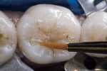 Figure 11 A diluted whitewash was applied to specific regions and faded to the adjacent enamel surfaces to correspond to the preoperative shade mapping and polymerized for 10 seconds.