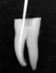 Radiograph showing master gutta percha point fit to length.