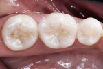 Figure 14a The postoperative result achieved with the use of this composite resin reflects the harmonious integration of natural tooth structure with restorative material and color.