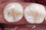 Figure 14b The postoperative result achieved with the use of this composite resin reflects the harmonious integration of natural tooth structure with restorative material and color.