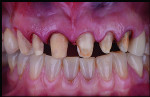 Fig 20. Two discolored metal posts are converted into tooth-colored buildups.