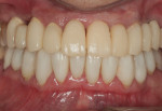 Fig 4. Porcelain laminate veneers cemented in the lower arch; provisional restorations shown on the upper teeth.
