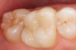 Figure 8  Typical CEREC® appearance.