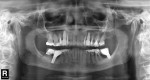 Fig 8. Final post-treatment panoramic radiograph.