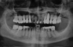 Fig 3. Pre-treatment panoramic radiograph.