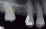 Fig 1. Periapical radiograph taken prior to EP removal. EP No. 1 is seen as a dense, smooth radiopacity on the mesial aspect of tooth No. 2.