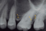 Fig 3. Periapical radiograph taken prior to EP removal. EP No. 2 can be seen on the interproximal area between teeth Nos. 13 and 14. EP No. 3 can be seen on the distal aspect of tooth No. 14. EP No. 4 can be seen on the mesial aspect of tooth No. 15.