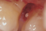 Fig 5. Intraoral photograph of EP No. 4 located on the mesial aspect of tooth No. 15.