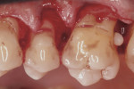 Fig 4. Intraoral photograph of EP No. 3 located on the distal aspect and furcation area of tooth No. 14.