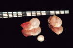 Fig 6. Extraoral photograph of EP Nos. 2 (upper left), 3 (upper right), and 4 (bottom) after their removal. Each mark on the periodontal probe is 1 mm.