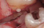 Fig 2. Intraoral photograph of EP No. 1 located on the mesial aspect of tooth No. 2.
