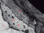 Fig 8. Electron microscopy of a histologic section of EP No. 2. The dentin surface (D) facing a dysplastic dentin (dD) shows evidence of clastic activity, indicating that this furrow was formed by cellular-based removal of the mineralized matrix. The secondary matrix that has filled in this furrow appears to be dysplastic dentin, containing some odontoblast tubules (OT). Overlying this secondary tissue is SFB with layers of various fiber directions. It is apparent that the dysplastic dentin is well integrated into the SFB. Field width = 400 μm.