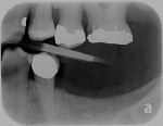 Fig 6. Initial radiographs showing dental condition and bone levels.