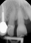 Fig 3. Initial radiographs showing dental condition and bone levels.