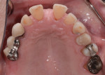 Fig 9. Preoperative occlusal view of the
maxillary arch.