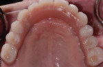 Fig 18. Occlusal view of the final fixed detachable restoration.