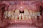 Fig 8. Preoperative retracted view in MIP showing flaring of the maxillary anterior teeth.