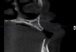 Fig 2. A pre-operative CT scan clearly showed the buccal concavity. It was used to measure the soft-tissue depth and assess the bone density, which was judged to be Type III.