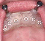 Fig 6. To facilitate placement of the angled narrow-diameter implants, a surgical guide was fabricated and secured in the patient’s mouth using fixation pins.