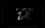 Fig 12. A postoperative CT scan confirmed that placement of the 20-degree angled implants followed the natural slope of the maxillary ridge.