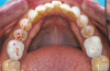 Fig 2. Immediate dentin sealing.
