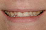 Figure 1  Preoperative 1:3 smile view of 15-year-old patient who presented 1 year afterorthodontic treatment with a request for moreesthetic teeth.