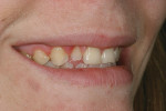 Figure 2  Preoperative right lateral 1:3 smile view.