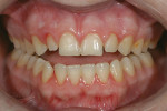 Figure 3  Preoperative 1:3 retracted view showingincisal wear and a reverse smile line, includingthe cuspids, spaces, inadequate width-to-lengthratios, and poor gingival health.