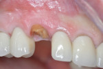 Fig 1. The endodontically treated root of tooth No. 6, which was free of inflammation after fracture of the coronal tooth structure retained with the restorative post and PFM crown.