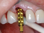 Fig 6. A long pick-up impression coping is attached to the implant after application of the particulate bone graft.