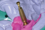 Fig 7. A rubber-based impression is obtained and an implant replica is attached to the coping prior to pouring a “working model” used to fabricate the temporary restoration.
