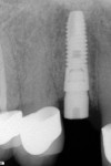 Fig 10. Radiograph taken immediately after
surgery. Implant position is evaluated in relation
to the adjacent teeth and proximal bone levels.