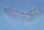 Fig 11. Vacuum-formed template fabricated on
the working cast of the patient prior to the fracture of the crown on tooth No. 6. This will be used with the model obtained from the surgical impression to form a screw-retained temporary crown on the bench top, rather than intraorally.