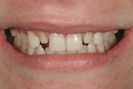 Figure 8  Frontal 1:3 view of the smile demonstratingthe more pleasing smile line with completionof the bonding of teeth Nos. 6, 8, 9, and 11.
