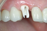 Fig 16. A zirconia CAD/CAM custom abutment with an abutment screw tightened to 25 Ncm. Note the healthy peri-implant soft tissues
and lack of appreciable soft-tissue recession.