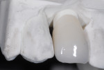 Fig 17. The final crown, porcelain pressed to an all-zirconia core, seated on the final abutment.