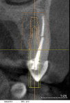 Fig 3. Cross-sectional image of tooth No. 6 obtained from a CBCT scan (GALILEOS, Sirona, www.sirona.com) taken several months earlier to facilitate implant placement in the maxillary posterior sextants. A Kan class I root position is noted for tooth No. 6, with proximity to the facial bone and substantial palatal bone available palatal and apical to the root. Primary stability can be anticipated in favorable situations such as the one depicted in this image.