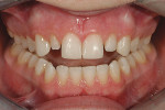 Figure 9  Retracted 1:3 frontal view showing theimproved width-to-length ratios, value/color, andgingival health.