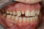 Figure 10  Retracted 1:3 right lateral viewrevealing the enhanced space remaining for theporcelain veneer.
