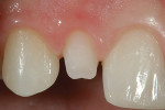 Figure 11a  Tooth No. 7 was prepared with abarely visible finishing line facially at the freegingival margin and slightly subgingival interproximally.Notice the texture and polish on the adjacentrestorations.