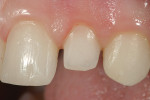 Figure 11b  Tooth No. 10 demonstrates thesame principles as tooth No. 7.