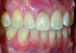 Fig 1. View showing generalized recession at upper anterior teeth and advanced bone loss and recession at lower left central incisor. Upper right central incisor had a hopeless prognosis.