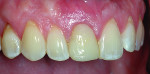 Fig 6. Healing 3 weeks after the tooth was extracted.