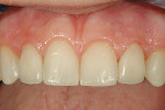 Figure 12  Retracted 1:1.5 view of the finalrestorations immediately after cementation.
