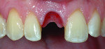 Fig 7. Bonded tooth removed. The tissue height was maintained with the properly contoured modified tooth acting as a provisional restoration.
